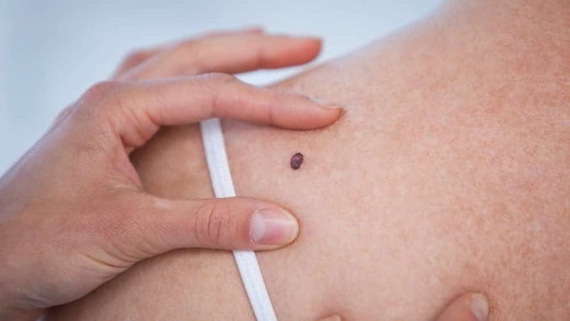 Indaial terá mutirão para atender casos suspeitos de câncer de pele