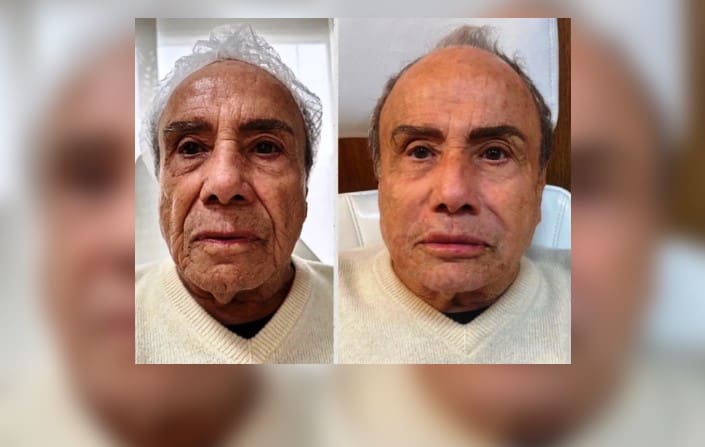 Stênio Garcia faz harmonização facial e vira piada na web
