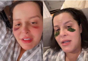 Após fraturar nariz, Maraísa aparece com manchas roxas no rosto