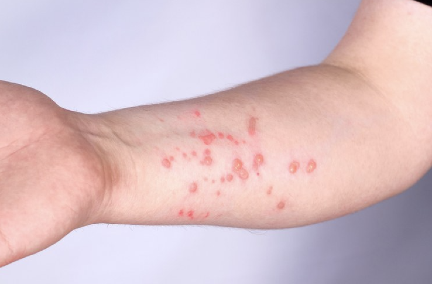 OMS alerta para variante mais perigosa de mpox