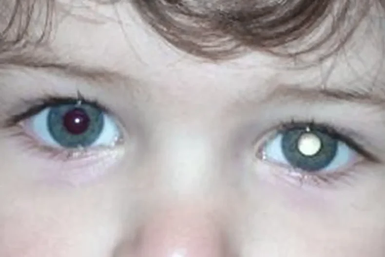 Alesc: Comissão aprova projeto de teste de retinoblastoma nas maternidades
