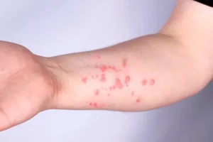 OMS afirma que não há risco de um pandemia de vírus mpox