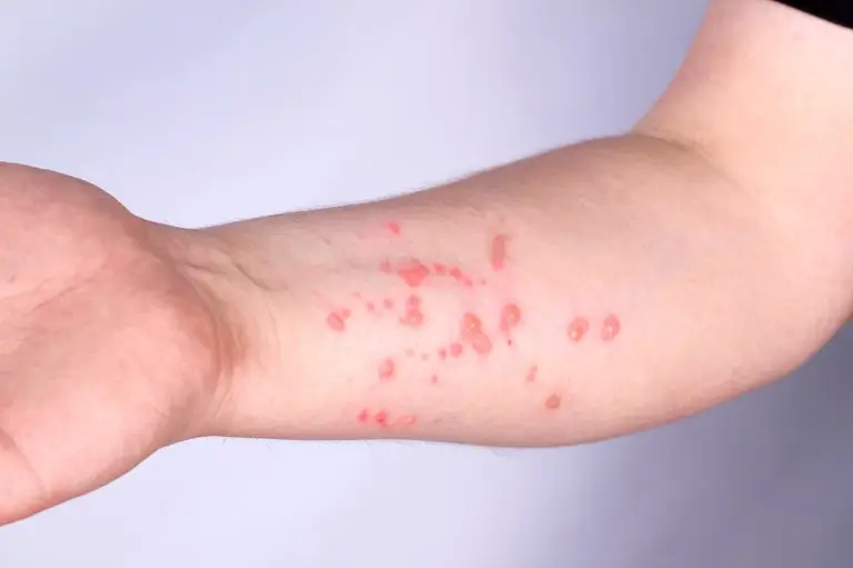 OMS afirma que não há risco de um pandemia de vírus mpox