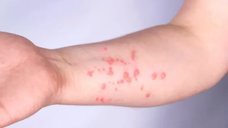 Florianópolis lidera o número de casos de Mpox no Estado