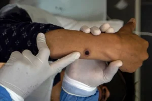 Nova cepa da Mpox é confirmada em São Paulo