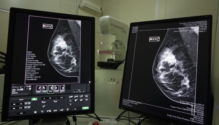 Governo de SC lança mutirão de mamografias no mês da Mulher 