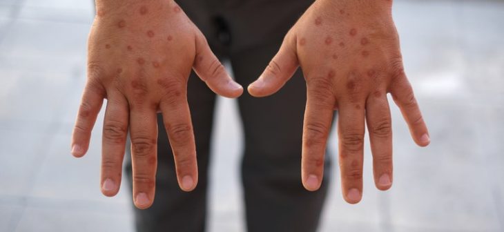 Cidade de SC confirma 1º caso de Mpox em 2025; paciente é monitorado