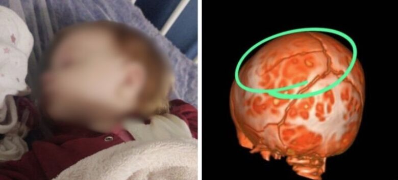 MP dá 48h para escola enviar imagens e explicar queda de bebê