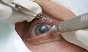 Cirurgia que altera cor dos olhos tem uso restrito para pessoas cegas