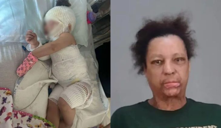 Bebê fica gravemente ferida após banho dado por babá
