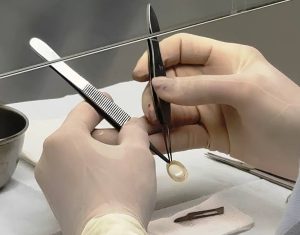 Bancos de Olhos garantem qualidade dos tecidos oculares doados em SC