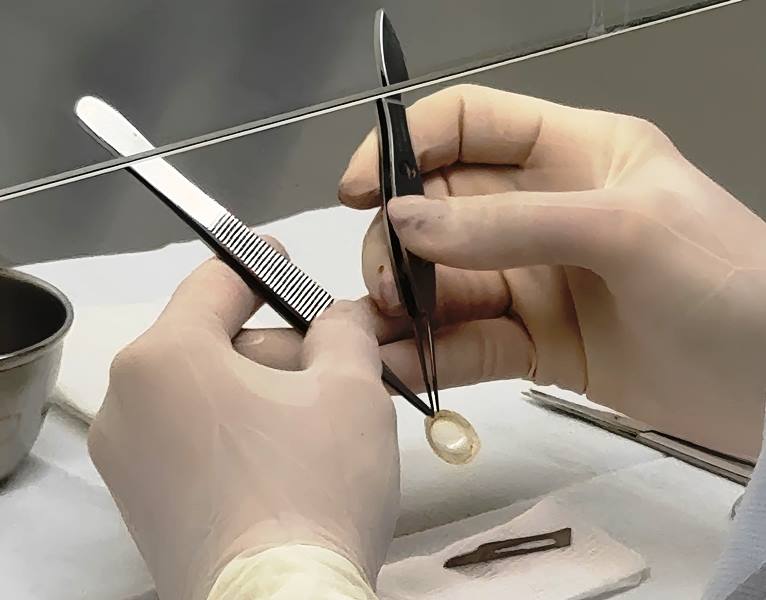 Bancos de Olhos garantem qualidade dos tecidos oculares doados em SC