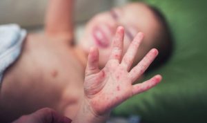 Casos de doença Mão-Pé-Boca em crianças preocupam autoridades de cidade do Vale