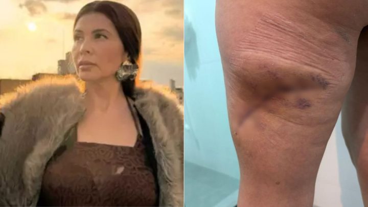Modelo tem pele necrosada após procedimento e esteticista será investigada