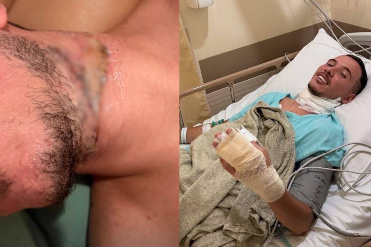 Motociclista ferido por cabo em Joinville recebe alta e se recupera em casa