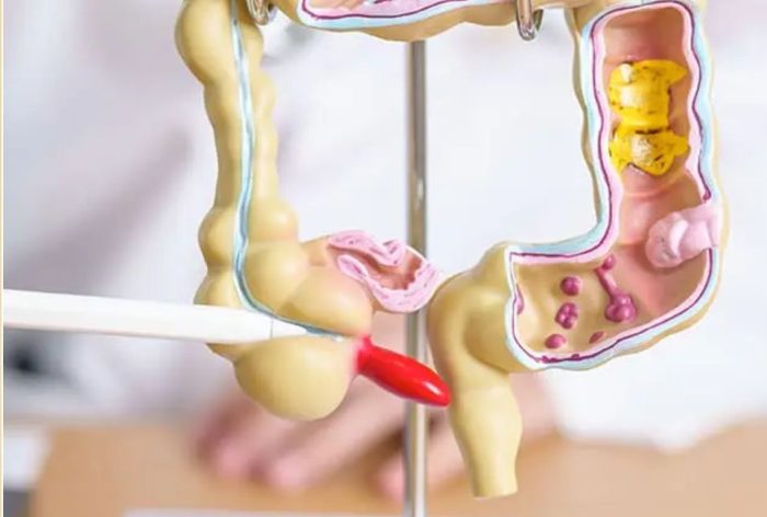 Câncer de intestino avança e médicos fazem alerta direto