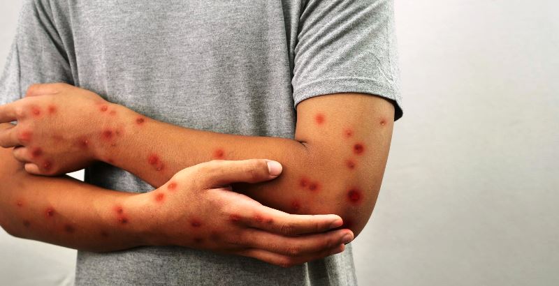 Cinco casos suspeitos de mpox seguem em análise em Santa Catarina