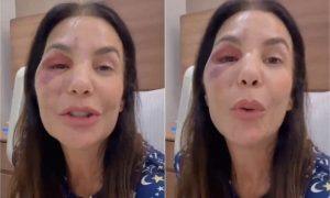 Ivete Sangalo passa por cirurgia no rosto; veja o resultado