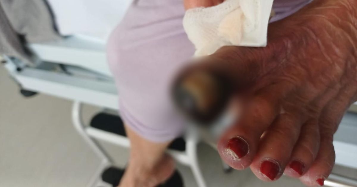 Idosa corre risco de amputação após ida à pedicure