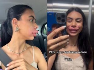 Miss Pomerode viraliza após reação nos lábios após procedimento