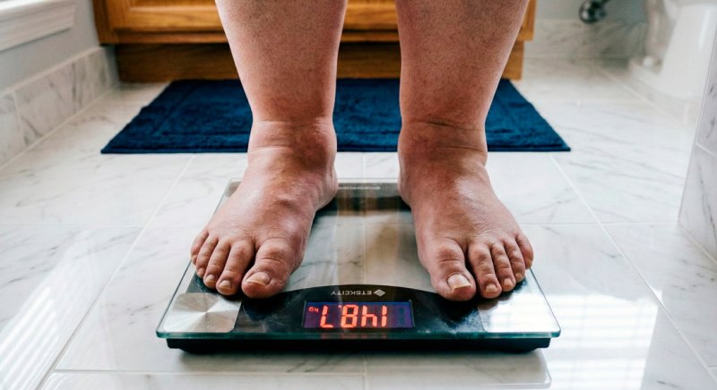 Obesidade se torna principal fator de risco à saúde no Brasil