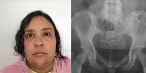 Falsa adolescente procurou hospital infantil com agulhas no corpo
