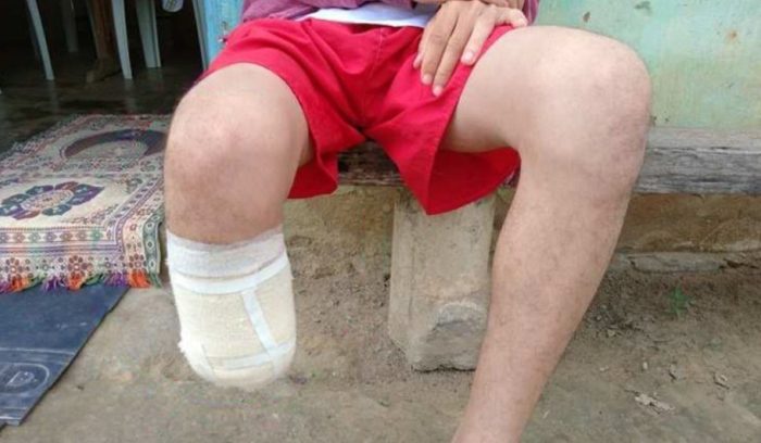 Homem é condenado por amputar o próprio pé para receber seguro