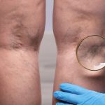 Dia Mundial da Trombose alerta para riscos e prevenção