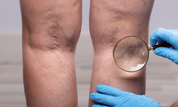 Dia Mundial da Trombose alerta para riscos e prevenção